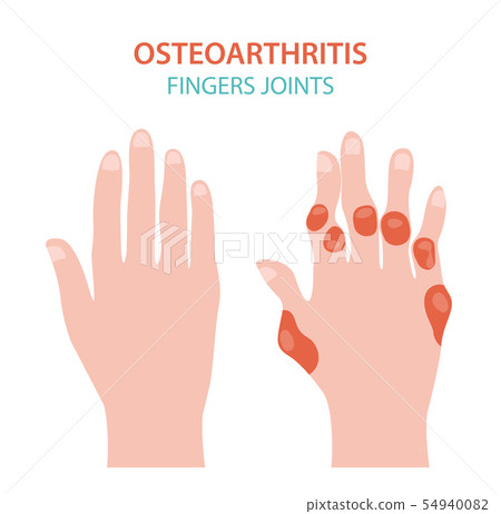 Arthritis, osteoarthritis medical infographic 54940082