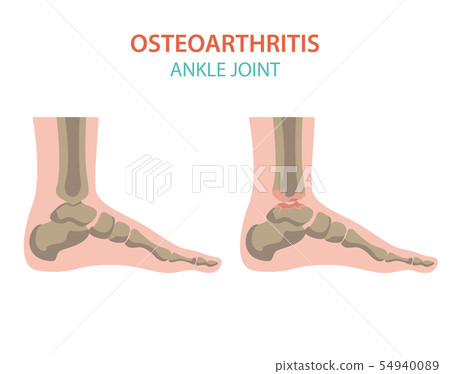 Arthritis, osteoarthritis medical infographic 54940089