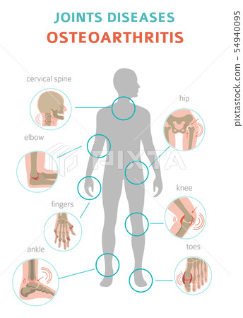 Arthritis, osteoarthritis medical infographic 54940095