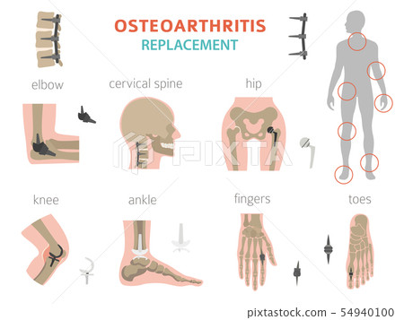 Arthritis, osteoarthritis medical infographic Arthritis, osteoarthritis medical infographic 54940100