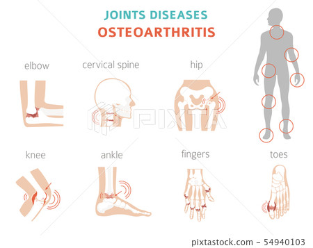 Arthritis, osteoarthritis medical infographic 54940103