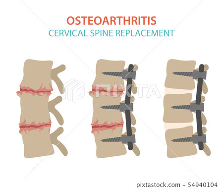 Arthritis, osteoarthritis medical infographic 54940104