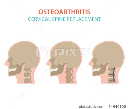 Arthritis, osteoarthritis medical infographic 54940106