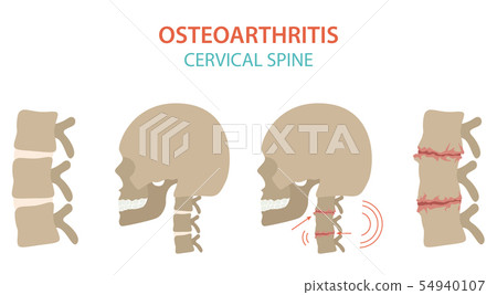 Arthritis, osteoarthritis medical infographic 54940107