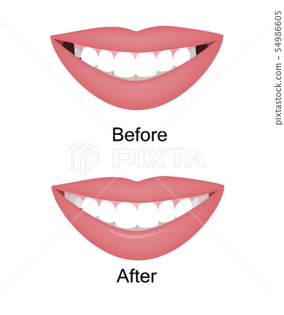 The smile with large and dark buccal corridor before and after correction. Vector illustration. Dark 54986605