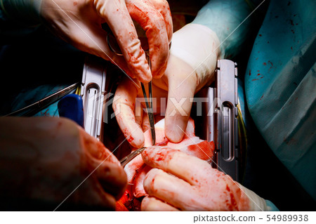 Suture of an lung emphysema surgery in an infant, Suture of an lung emphysema surgery in an infant, 54989938