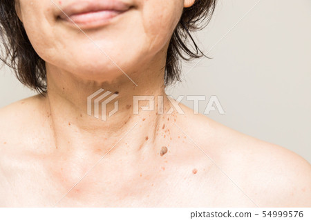 Senile sexual pregnancy wart 54999576