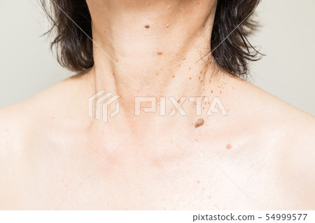 Senile sexual pregnancy wart 54999577