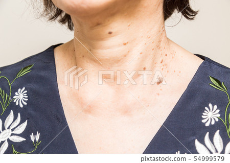 Senile sexual pregnancy wart 54999579