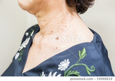 Senile sexual pregnancy wart Senile sexual pregnancy wart 54999819