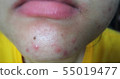 Red spot and chin acne ,selective focus 55019477