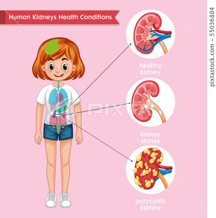 Scientific medical illustration of kidney disease Scientific medical illustration of kidney disease 55036884