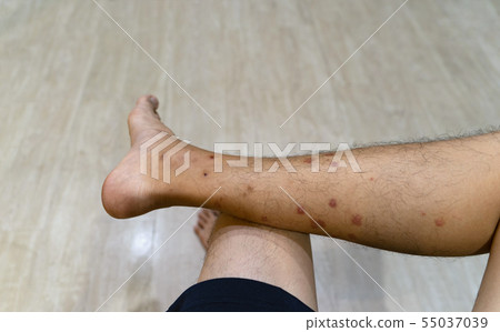 Close up of a man leg with allergy to insect, 55037039
