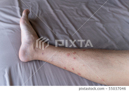 Close up of a man leg with allergy to insect, 55037046