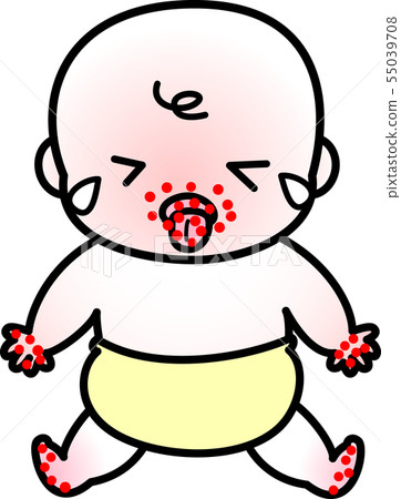 手足口病寶寶 55039708