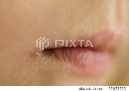 skin problems, angulitis, angular stomatitis, skin problems, angulitis, angular stomatitis, 55075735
