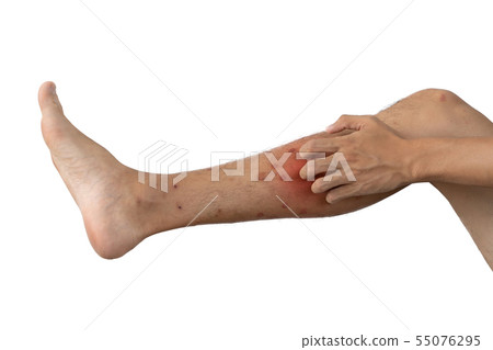 Close up of a man leg with allergy to insect, Close up of a man leg with allergy to insect, 55076295