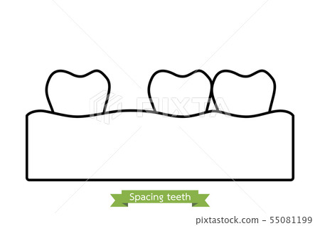 spacing teeth ( diastema ) spacing teeth ( diastema ) 55081199