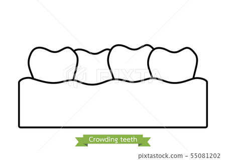 crowding teeth ( malocclusion ) crowding teeth ( malocclusion ) 55081202