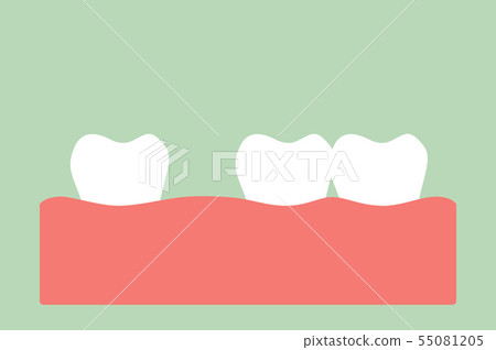 spacing teeth ( diastema ) 55081205