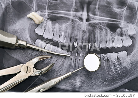 Dental instruments with tooth lying on orthopantomogram 55103197