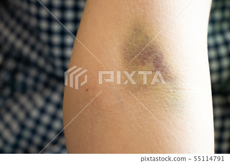 Bruise injury on the female arm background Bruise injury on the female arm background 55114791