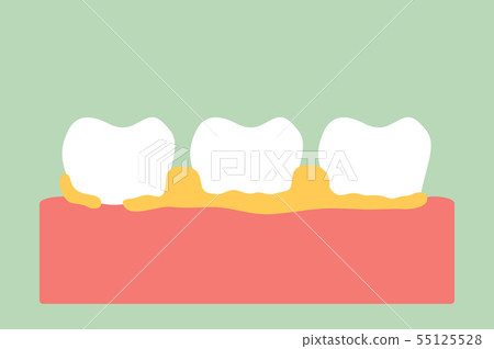 periodontal disease with dental plaque or tartar 55125528