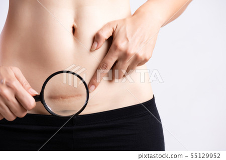 Closeup of woman showing on her belly dark scar 55129952