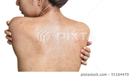 Young Asian woman have acne with red spots on the 55164470