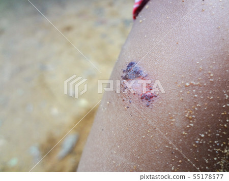Wound on the elbow of a child Caused by accidents Wound on the elbow of a child Caused by accidents 55178577