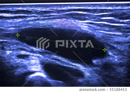 EPI dry needling ultrasound scan 55188453