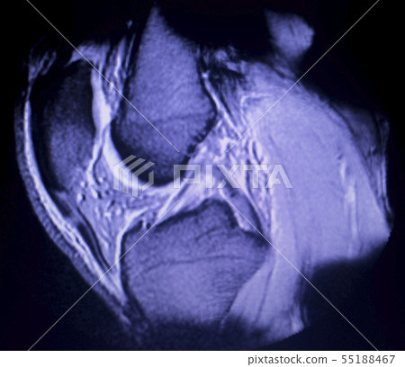 MRI knee meniscus tear scan 55188467