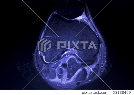 MRI knee meniscus tear scan 55188469