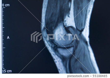 Knee injury mri mcl tear Knee injury mri mcl tear 55188485