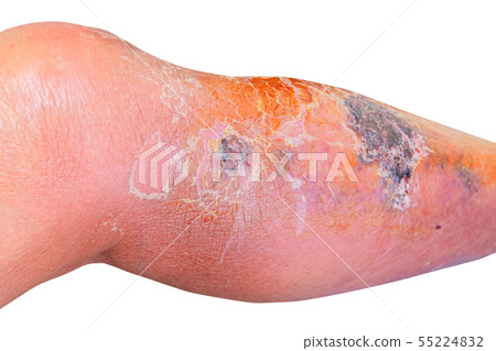 Erysipelas bacterial infection Under skin leg Erysipelas bacterial infection Under skin leg 55224832