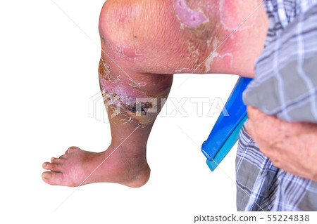 Erysipelas bacterial infection Under skin leg 55224838