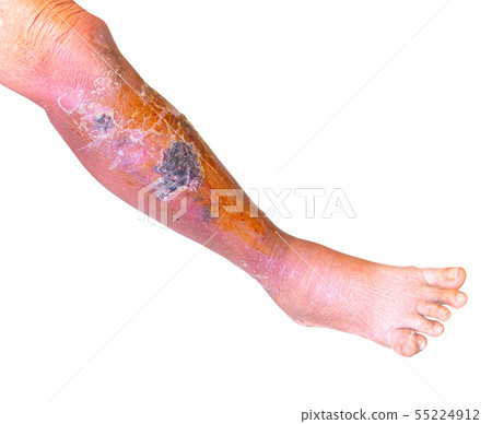 Erysipelas bacterial infection Under the skin leg 55224912