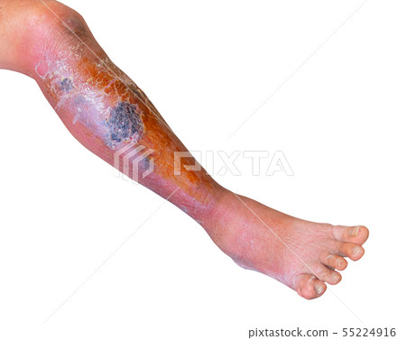Erysipelas bacterial infection Under the skin leg 55224916