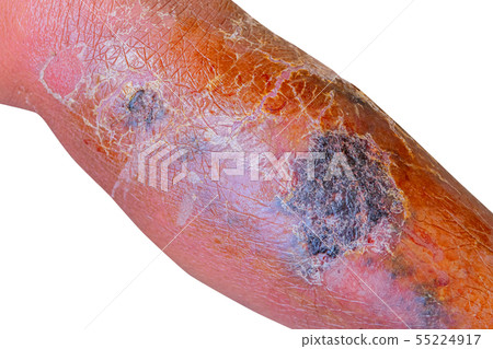 Erysipelas bacterial infection Under the skin leg 55224917