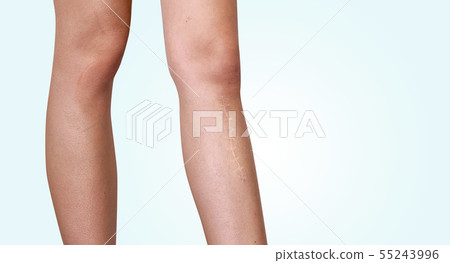 The scar on the leg. Bone fracture or tumor removal. Recobvery. isolated medical on white background The scar on the leg. Bone fracture or tumor removal. Recobvery. isolated medical on white background 55243996
