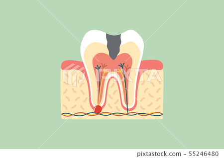 decay tooth anatomy structure 55246480