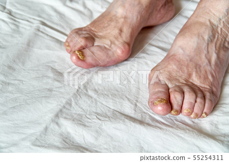 Closeup of a foot with damaged nails because of fungus. Elderly woman legs. Diabetis Closeup of a foot with damaged nails because of fungus. Elderly woman legs. Diabetis 55254311