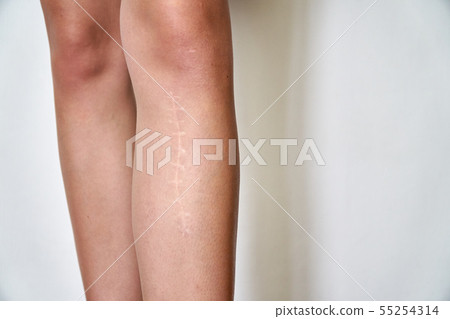 The scar on the leg. Bone fracture or tumor removal. Recobvery. isolated medical on white background The scar on the leg. Bone fracture or tumor removal. Recobvery. isolated medical on white background 55254314
