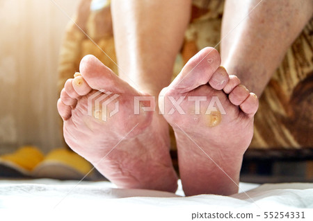 An elderly woman feet with podagra, fungus and diabetic ucler, callus. Healthcare concept 55254331