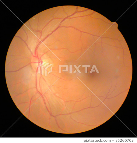 retinal retinal 55260702