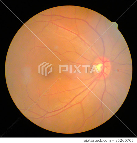 retinal retinal 55260705