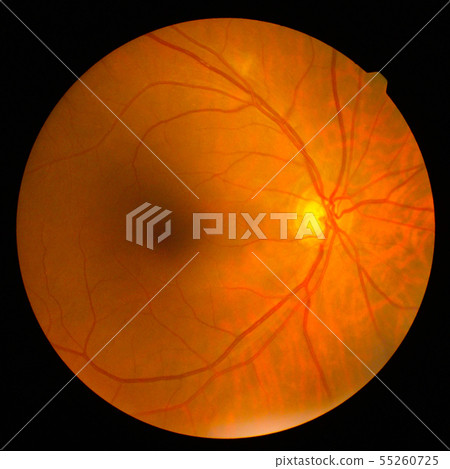 retinal retinal 55260725