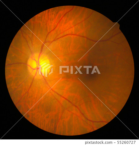retinal 55260727