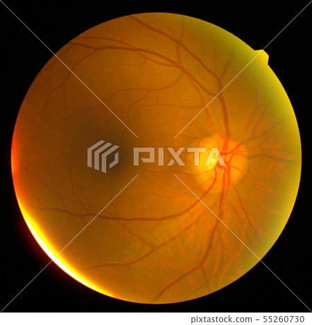 retinal retinal 55260730