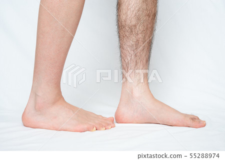 Men's Leg Hair Removal Before & After Image One Leg Only Men's Leg Hair Removal Before & After Image One Leg Only 55288974